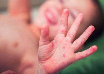 Crianças que contraem síndrome mão-pé-boca devem ser afastadas de ambientes coletivos, diz pediatra