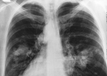 Exame de sangue identifica indivíduos com chance de desenvolver câncer de pulmão, diz OMS