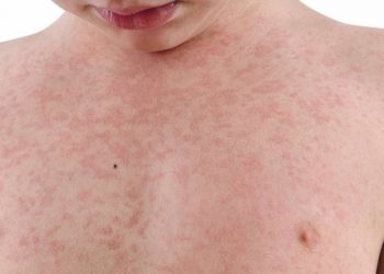 Surto de sarampo faz prefeitura de Monte Alegre decretar situação de emergência