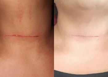 Motoqueira é atingida no pescoço por linha de pipa com cerol em Itaituba