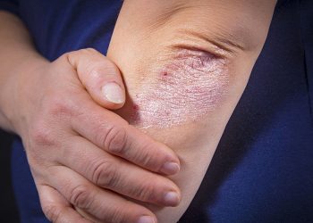 SUS oferece mais quatro medicamentos para o tratamento da psoríase
