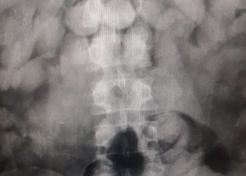 Suspeitos de tráfico internacional em Belém recebem alta após expelirem 5 kg de cocaína que seriam levados para França