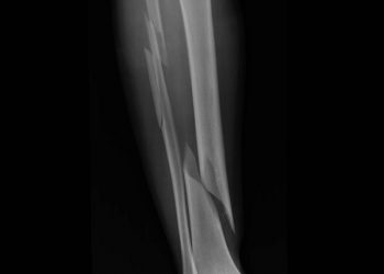 Paciente com fratura aguarda leito para ser transferido de Medicilândia para outro hospital