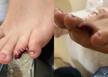 Paraense perde parte do dedo após ser atacada por peixe