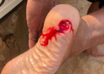 Banhista é atacado por piranha no Rio Tapajós; este é o 12° caso em dois meses