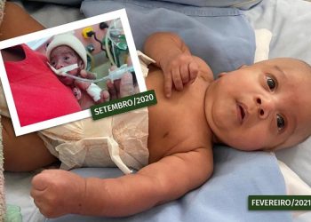 Após lutar 5 meses pela vida, bebê prematuro recebe alta no Hospital Regional Público da Transamazônica