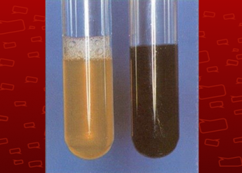 O que é doença de Haff ou “da urina preta”