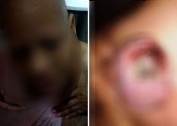 Estado nega cirurgia para paciente com câncer severo no seio e família pede ajuda no Pará