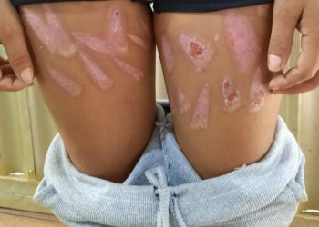 Jovem sofre tortura e tem corpo queimado com uso de faca em Porto de Moz, no Pará