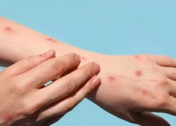 Lesões na pele são sintomas comuns em pacientes com varíola dos macacos (Divulgação / OMS / Imagem ilustrativa)