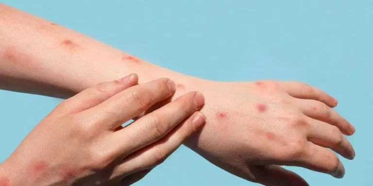 Lesões na pele são sintomas comuns em pacientes com varíola dos macacos (Divulgação / OMS / Imagem ilustrativa)
