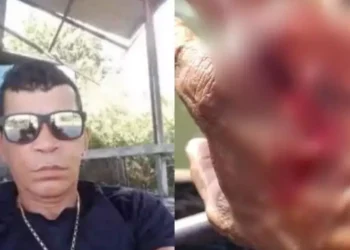 A imagem em destaque mostra o pescador atacado pelo jacaré (à esquerda) e a mão dele após o ataque (à direita). (Foto: Reprodução | Giro Portal)