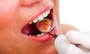 Altamira promove 1º Mutirão de Rastreamento do Câncer de Boca com atendimento em todas as UBSs