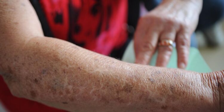 Novos casos de câncer devem quase dobrar até 2050, alerta OMS