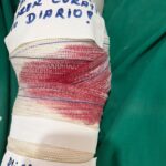 Paciente com fratura exposta é transferida para hospital de referência após dois dias de espera em Medicilândia